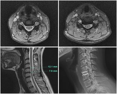 Case report: Recurrent cervical spinal stenosis masquerading as myalgic encephalomyelitis/chronic fatigue syndrome with orthostatic intolerance
